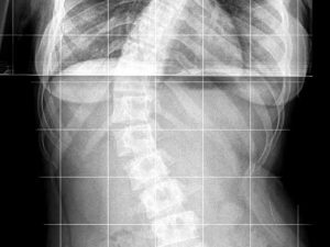 My spinal cord Xray